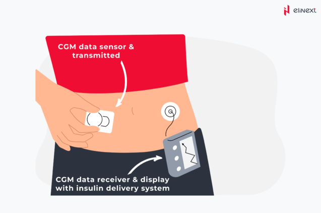 Real-time continuous glucose monitoring (rtCGM)