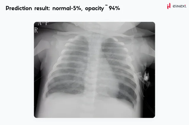 An automated pneumonia diagnosis tool